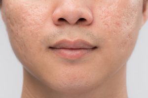 Up close photo of a person with acne scars on the face