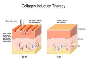 A depiction of how microneedling works to smooth skin on the body.