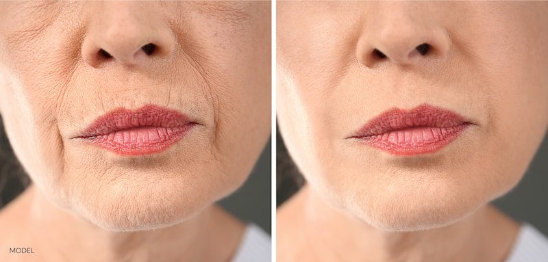 Before and after image showing the results of a laser or ultherapy treatment.