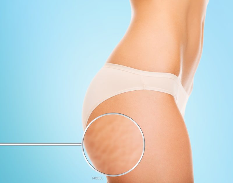 Close-up side image of woman's abs and thighs with magnifying glass over cellulite pocket against a blue background.