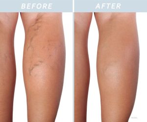 Photos of varicose veins before and after treatment