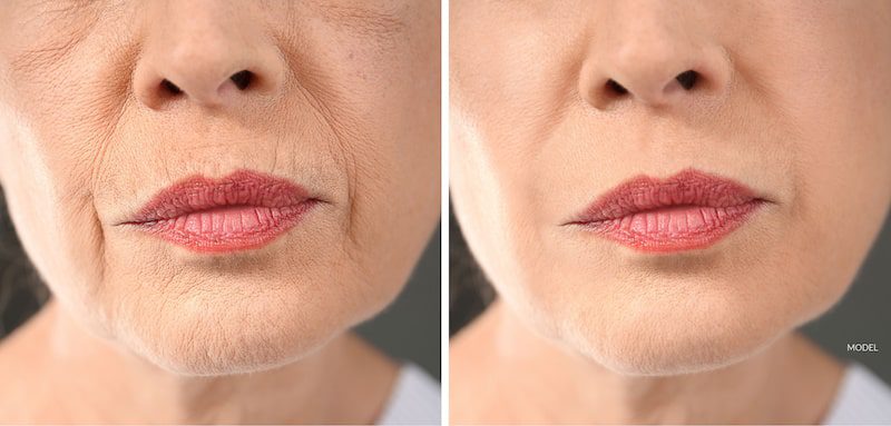 Before and after treatment showing results of a lip wrinkle treatment.