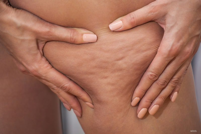 Close-up image of a woman's cellulite on her leg