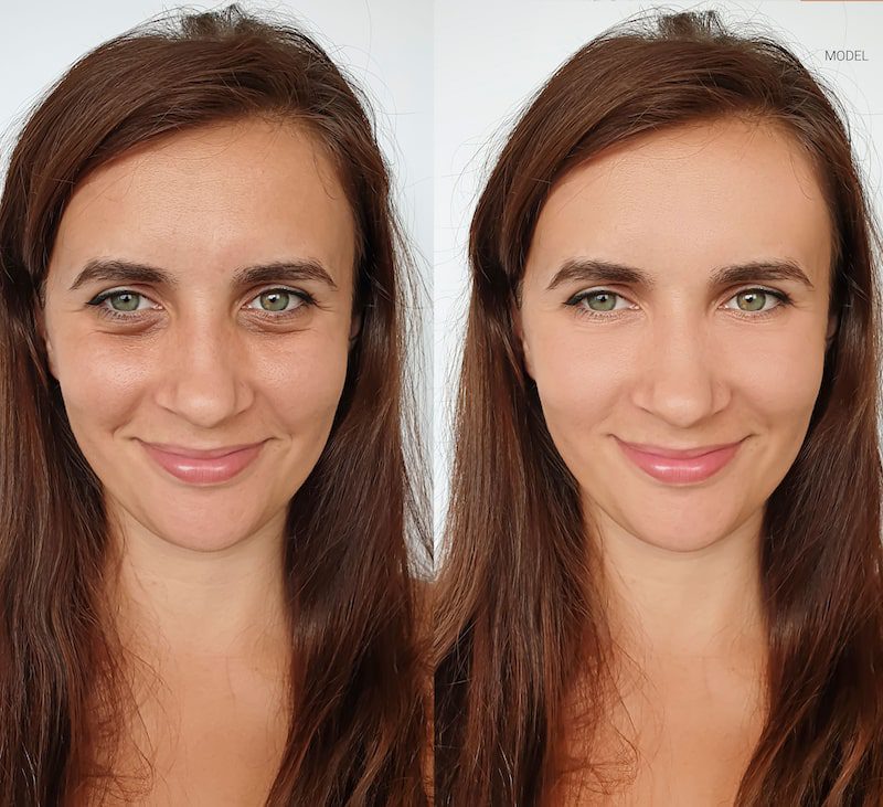 Woman before and after a facial treatment to restore volume beneath her eyes.